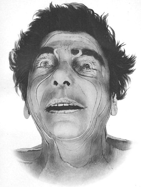 Man's face showing lines of incision.