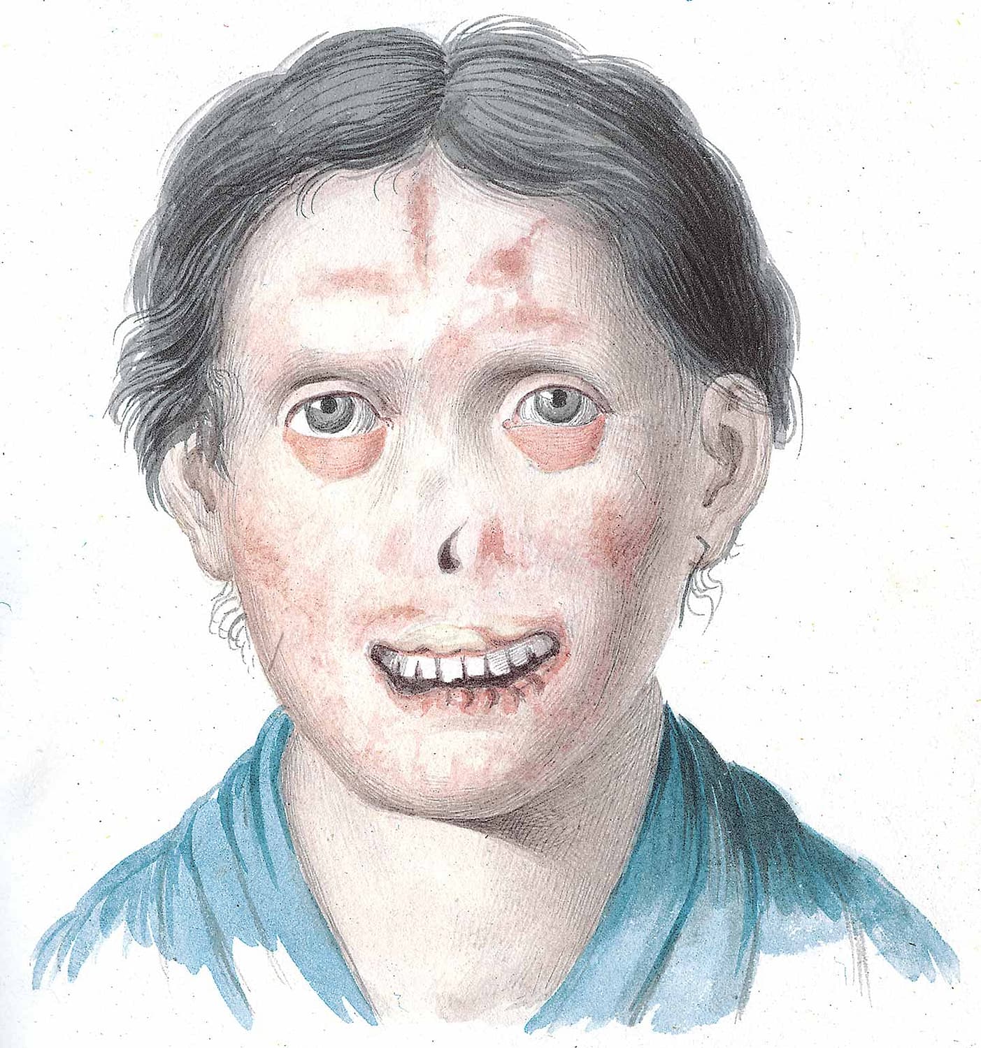 Woman with facial lesions.